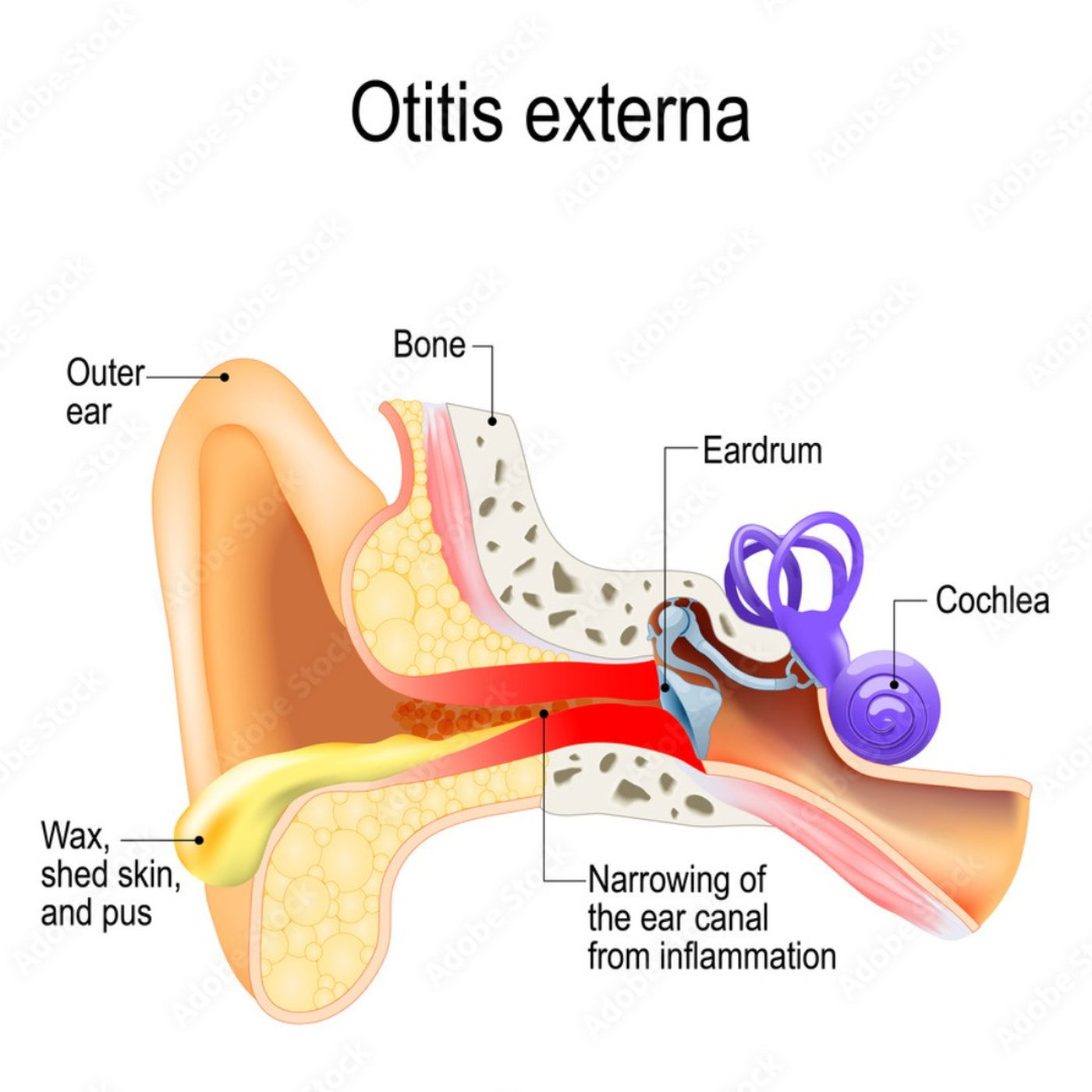 14 Des 22 - Gesondheidsake: Swimmers ear of Otitis externa episode artwork