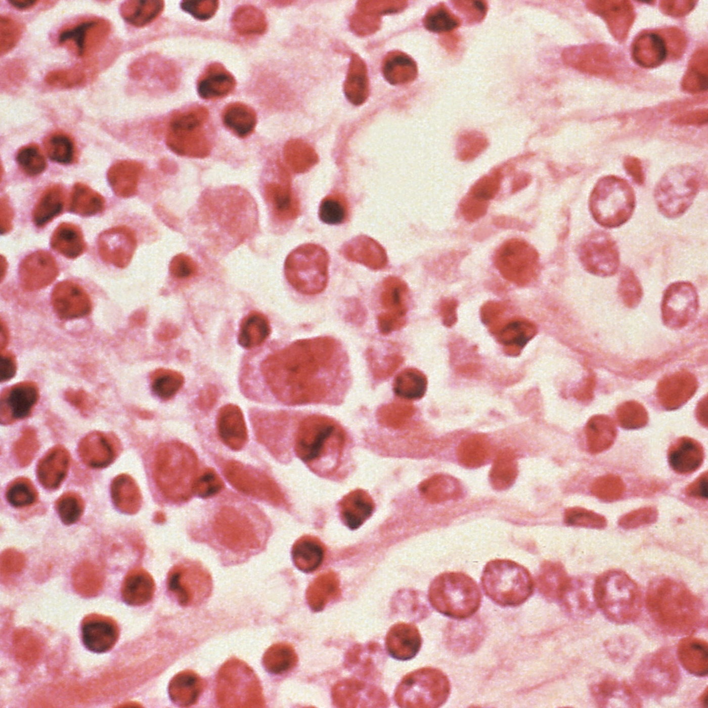 WHO: Hantavirus may have spread between humans episode artwork