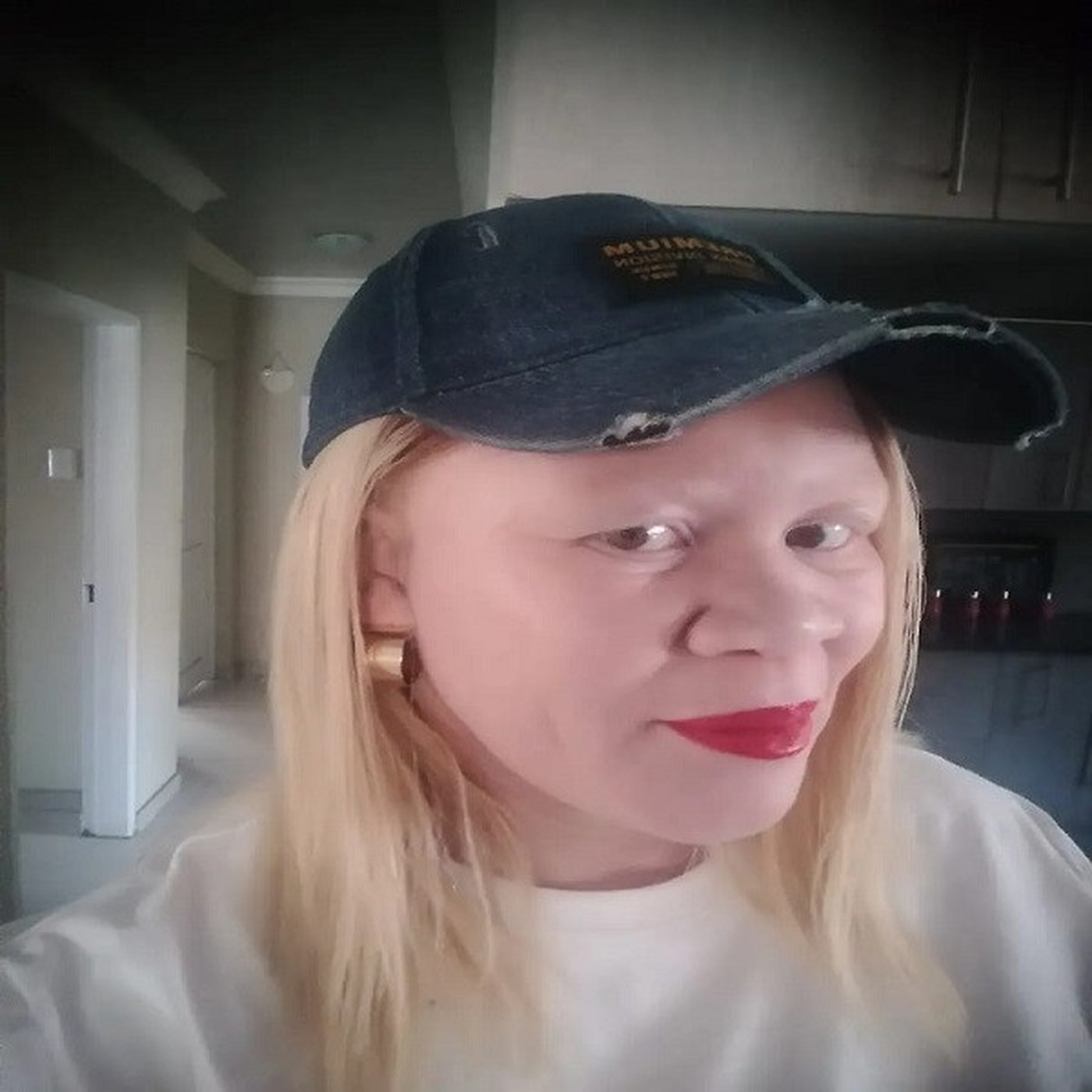 Skin Cancer Awareness for people living with Albinism #HealthTalk episode artwork